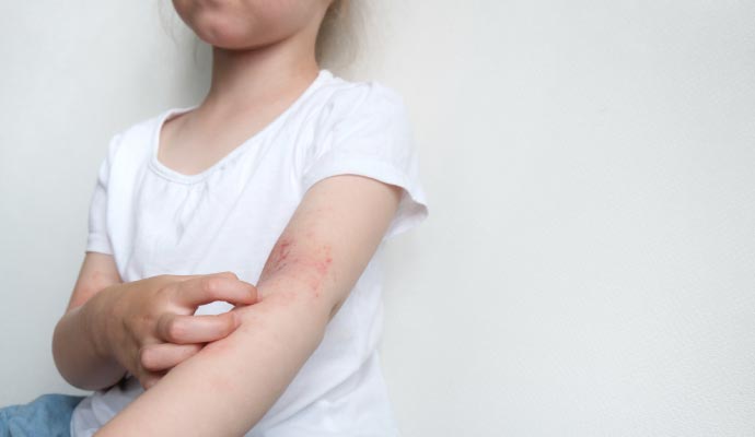 Allergy affected children